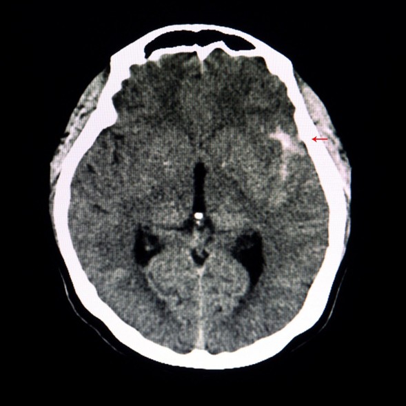 Aneurisma Cerebral