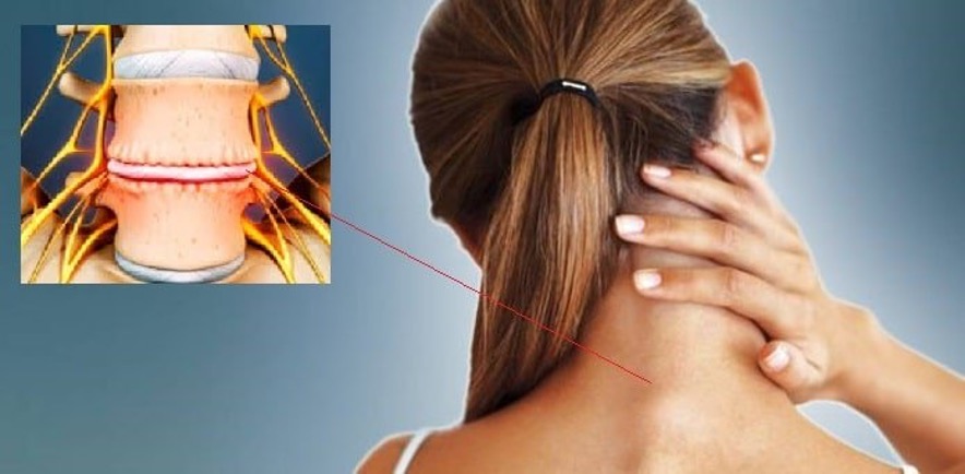 Artroplastia discal cervical : Tratamiento