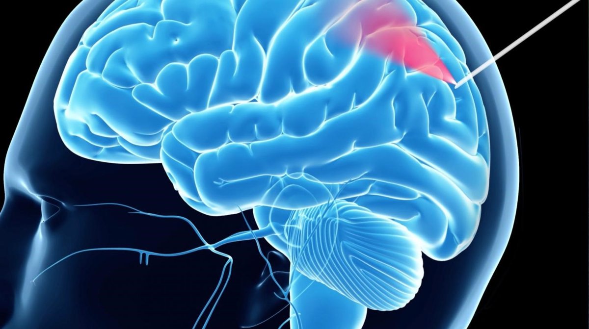 biopsia cerebral