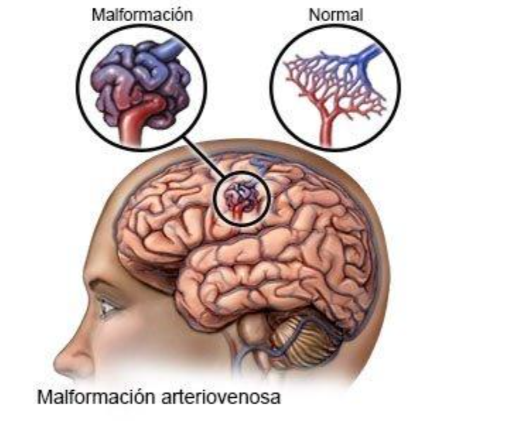 Malformación Arteriovenosa