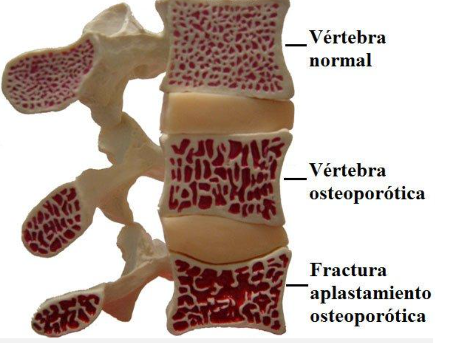 Osteoporosis de Columna Vertebral