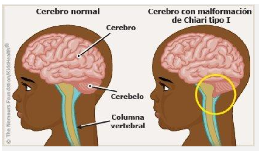 Malformaciones de Chiari
