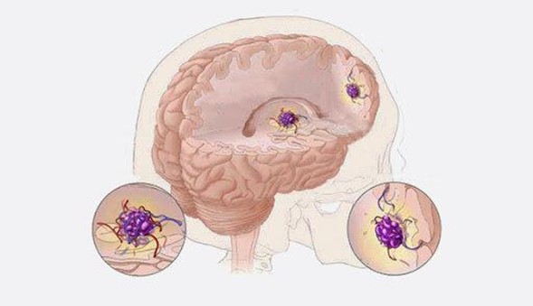 cavernoma cerebral