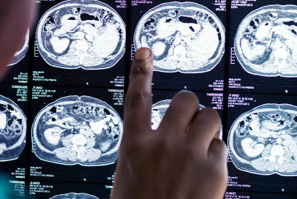 Mujer con dolor de cabeza por tumor cerebral, ilustración de diagnóstico neuroquirúrgico en Panamá