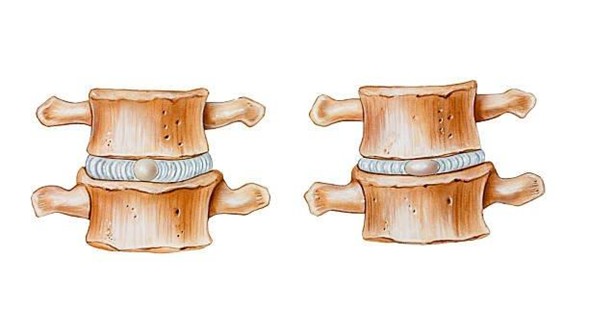 deshidratación del disco intervertebral