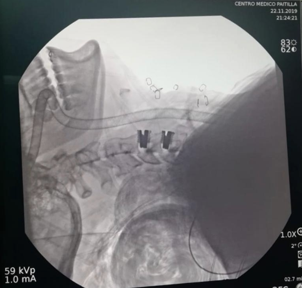 Acude a consulta con un neurocirujano si tienes Dolor en el cuello