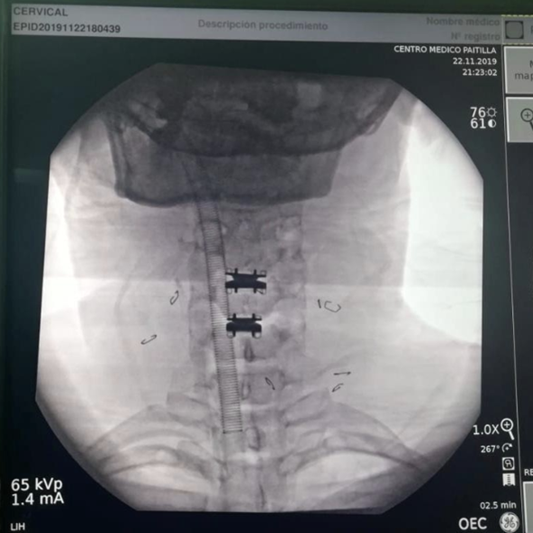 Dolor en el cuello