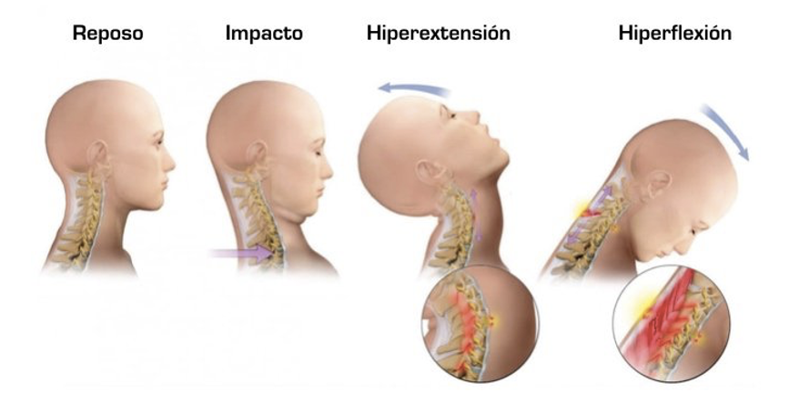 ¿Qué Es El Esguince O Latigazo Cervical?Explicación