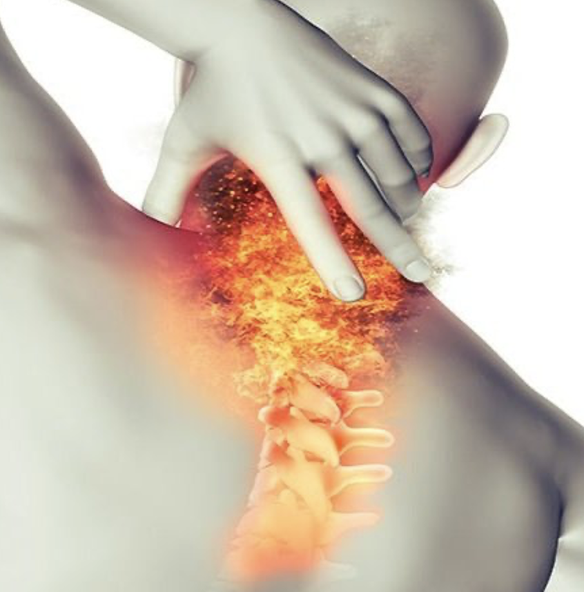 Esguince o latigazo cervical