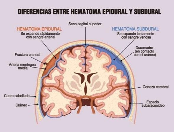 Hematoma Subdural Crónico