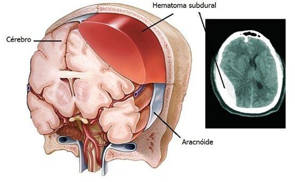 Hematoma subdural cronico