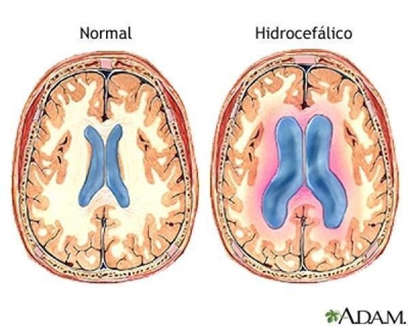 Hidrocefalia