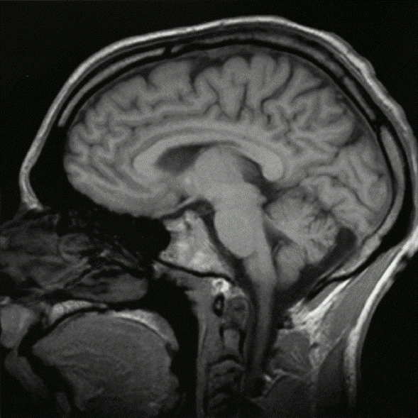 Hipertension Intracraneal Idiopatica
