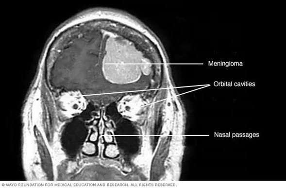 Meningioma Cerebral