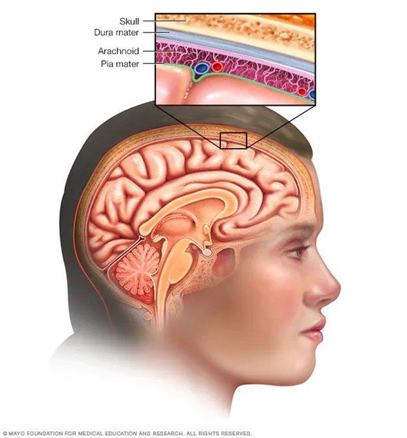 Meningioma Cerebral