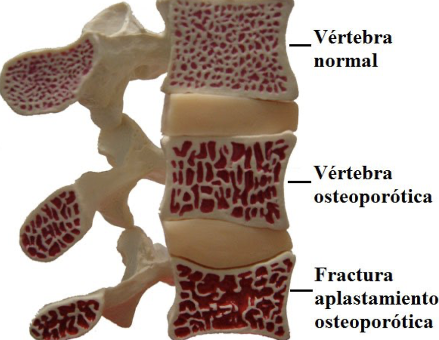 Osteoporosis de Columna Vertebral