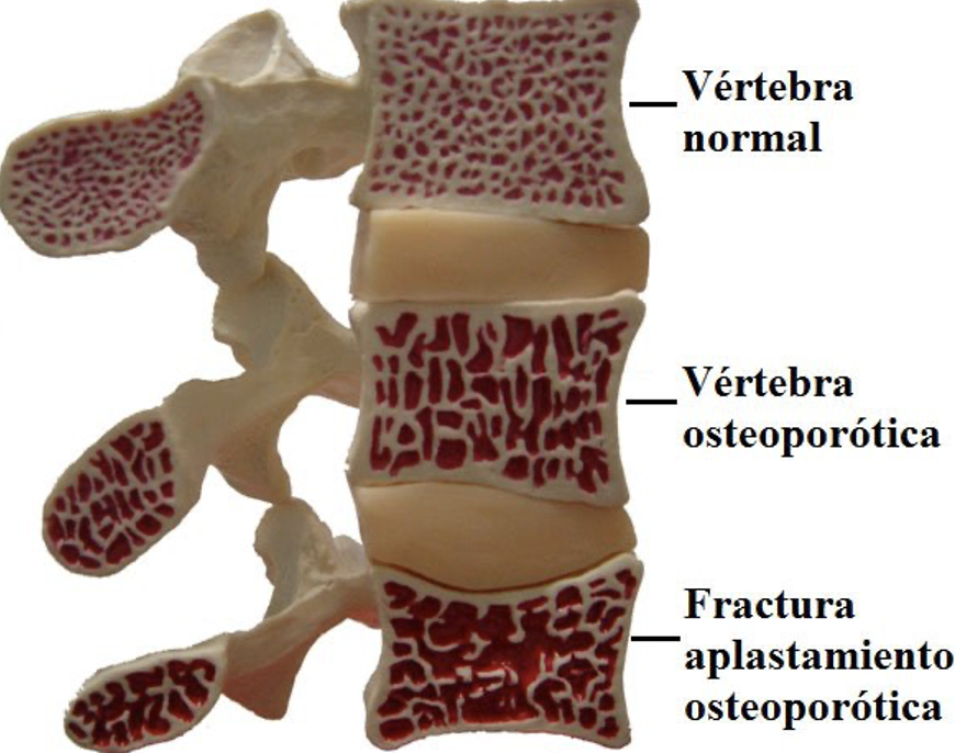 Osteoporosis de Columna Vertebral
