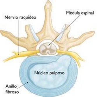 roturas anulares
