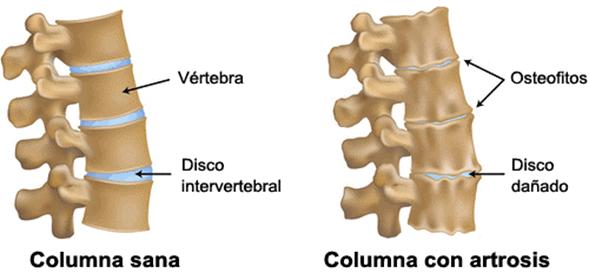 Artrosis lumbar