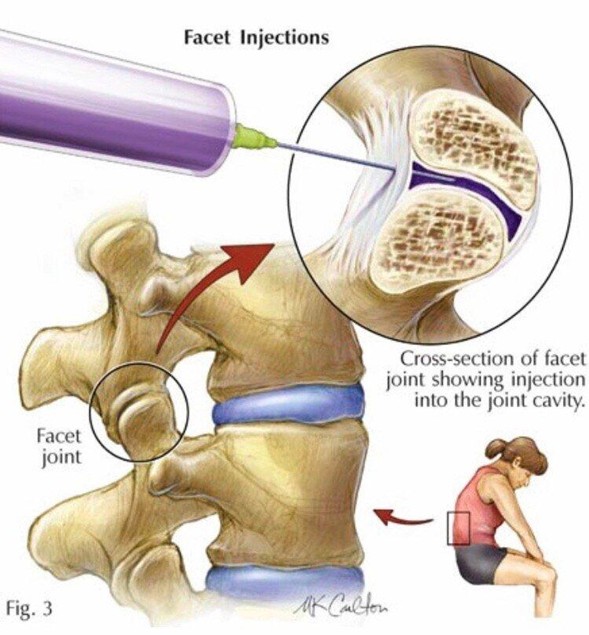 Bloqueos Facetarios Cervicales y Lumbares