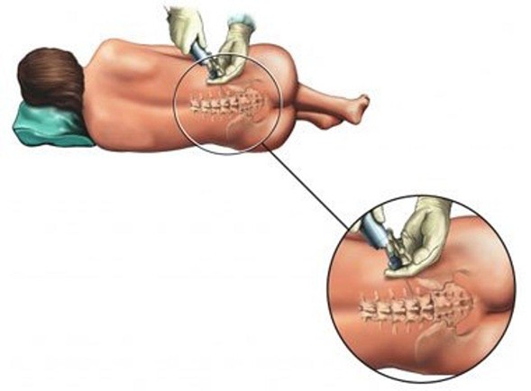 tratamiento de la ciática y el dolor lumbar