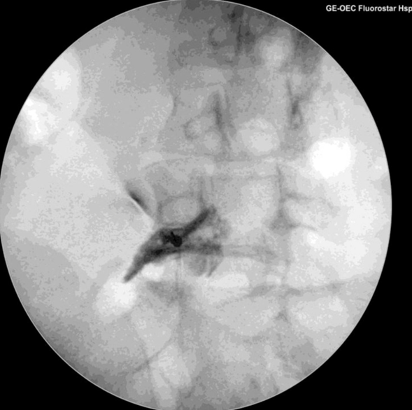 Solución no quirúrgica para el tratamiento de la ciática y el dolor lumbar