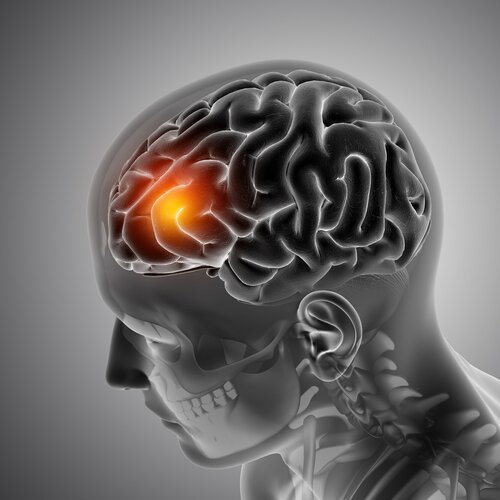 Cirugía de Tumor Cerebral + Testimonio