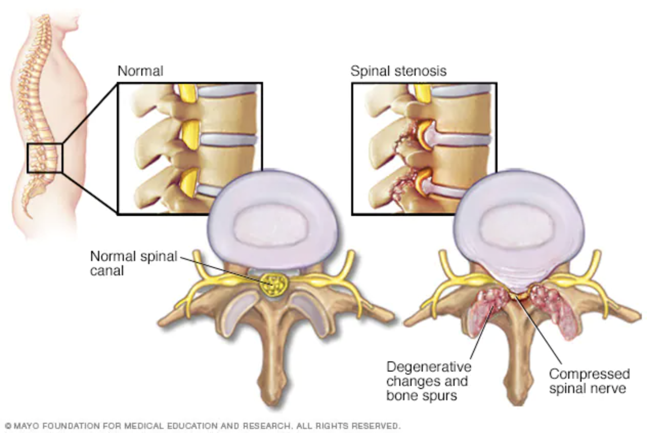 estenosis del conductro vertebral