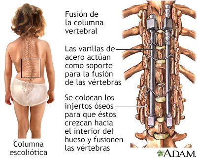 fusión espinal