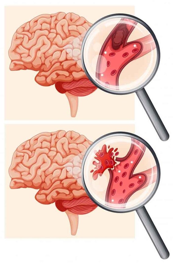 infarto cerebral