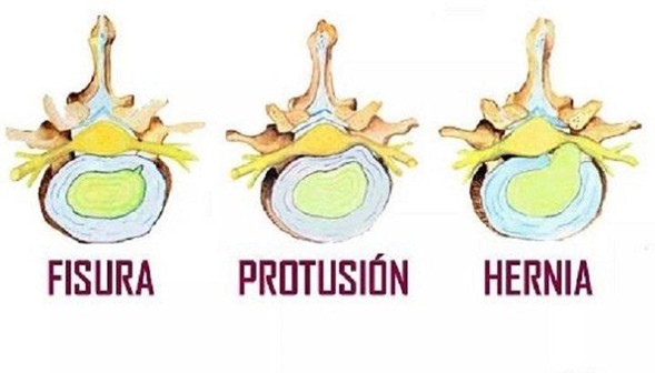 protusion discal