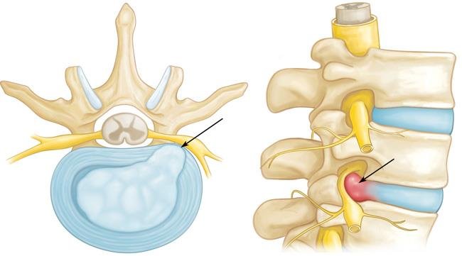 Radiculopatía Cervical: Síntomas, Causas y Tratamiento en Panamá